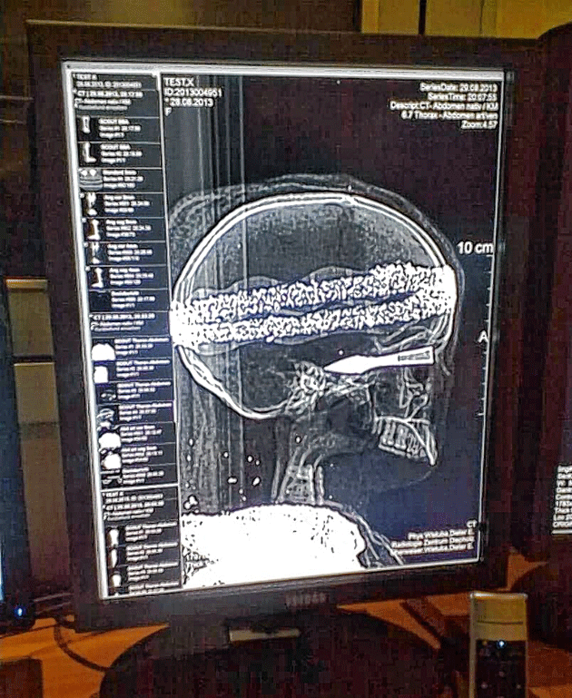 Die Röntgenaufnahme zeigt: Der Schädel ist echt.