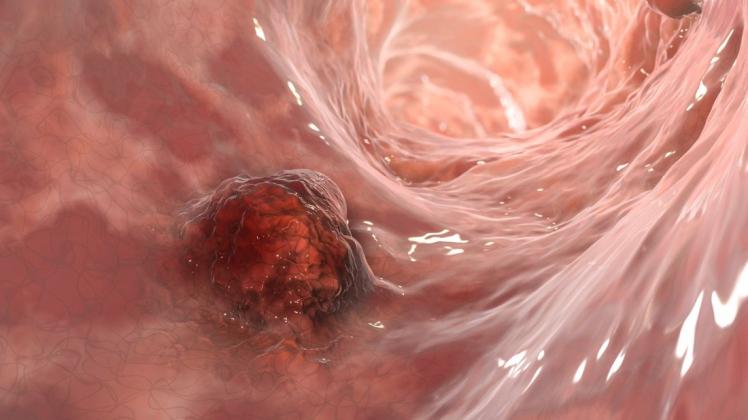 Wucherungen im Darm können sich zu Tumoren entwickeln, die zum Organversagen führen können. (Illustration)