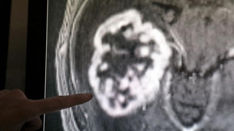Krebs-Diagnostik in der Radiologie.