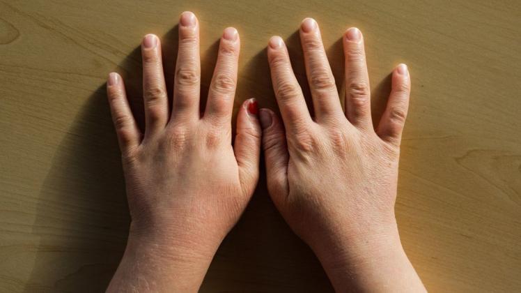 Das sind die Hände der 9-jährigen Ida. Vor einem Jahr waren sie noch stark gezeichnet von einer extremen Neurodermitis. Aufgrund einer Therapie am Christlichen Kinderhospital unter Leitung der Ärztin Britta Zobel sind die Auswirkungen der Krankheit stark zurück gegangen.