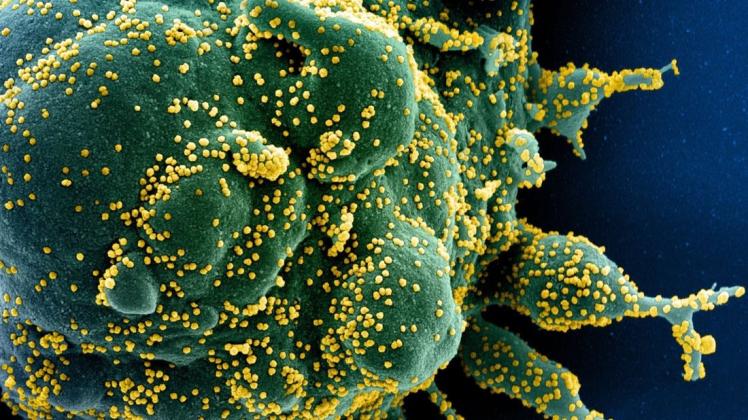 So sieht das Coronavirus unter dem Mikroskop aus. Die Zelle (grün) ist mit dem Coronavirus (SARS-CoV-2, gelb) infiziert.