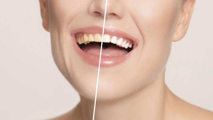 Viele Menschen wünschen sich weißere Zähne. Dabei soll Bleaching helfen. (Symbolbild)