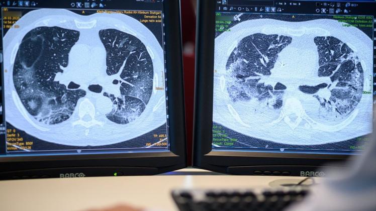 Computertomographieaufnahmen der Lunge eines Covid-Patienten.
