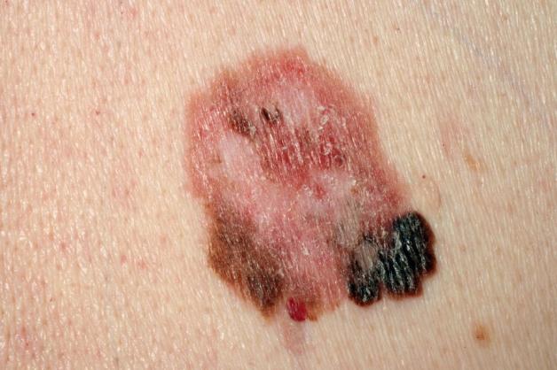 Solarien-Verbot in Deutschland? Das rät ein Hautarzt | NOZ