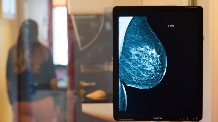 Die gesunde Brust einer Frau ist hier auf einer Röntgenaufnahme zu sehen. Das Mammographie-Screening hilft bei der Früherkennung.