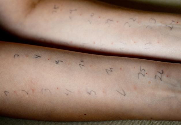 Wie eine Tabelle sieht der Allergietest auf dem Arm aus. Jeder Pieks ist ein anderer Stoff, gegen den man allergisch sein könnte. 