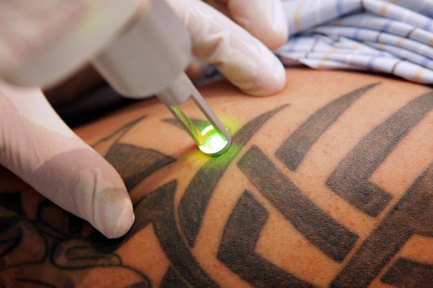 Ein Mann lässt sich seine Tätowierung mit Hilfe eines starken Lasers entfernen.  