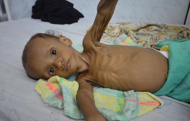 Der zweijährige Mohammed wird 2016  wegen Unterernährung in der Thawra-Klinik in al-Hudaida im Jemen behandelt.