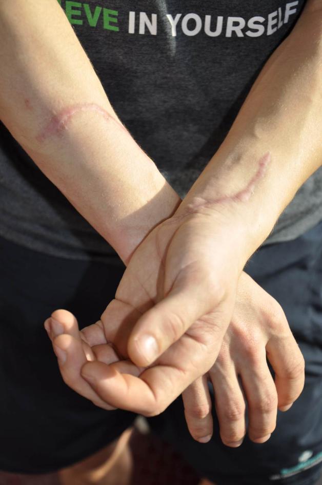 Diese Narben werden Torsten Kröger immer an seinen Horrorsturz im September 2013 erinnern, als ihm Schlittschuh-Kufen beide Unterarme aufschlitzten und  mehrere Sehnen durchtrennten.