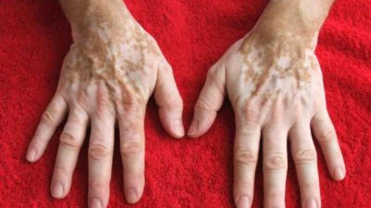  Weiße Flecken sind die einzigen Anzeichen von Vitiligo - andere Symptome gibt es nicht. Dafür aber viele Begleiterkrankungen, zum Beispiel Probleme mit der Schilddrüse. Foto: Deutscher Vitiligo-Bund e.V./Georg Pliszewski 
