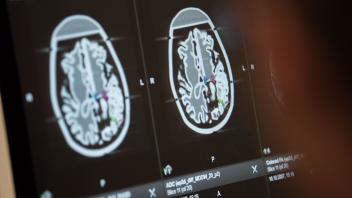 Neurologe: Covid-19 könnte auch das Hirn befallen