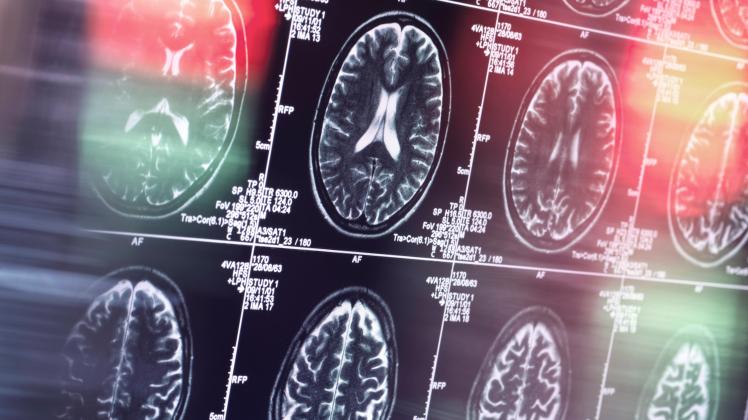 MRI scan of brain in clinic model released property released, ABRF00930