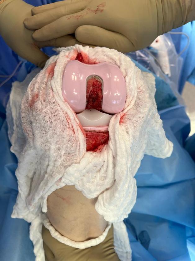 Erstmals Kniegelenk aus Keramik im Krankenhaus Thuine implantiert