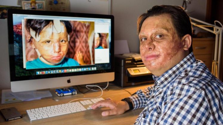 Marc-David Jung wurde vor 30 Jahren als Vierjähriger bei der Flugtagkatastrophe von Ramstein schwer verbrannt. Foto: dpa/Oliver Dietze