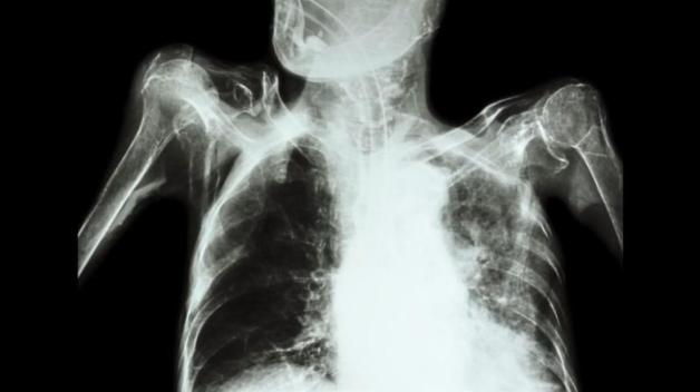 Röntgenaufnahme einer Lungentuberkulose. Foto: Colourbox.de