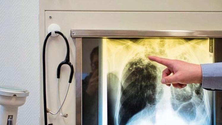 Tuberkulose-Fall auf einem Röntgenbild im Tuberkulosezentrum Berlin-Lichtenberg. 