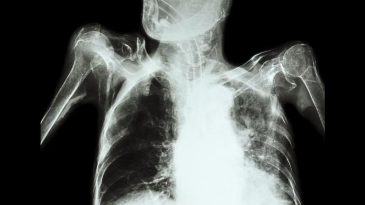 Röntgenaufnahme einer Lungentuberkulose. 