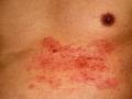 Gürtelrose oder Herpes zoster im Brustbereich bei einem 56 jährigen Mann mehrere Dermatome sind be