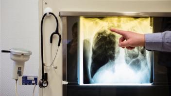 In Deutschland sind Tuberkulose-Fälle selten, treten aber dennoch regelmäßig auf. Mit Medikamenten lässt sich die Krankheit heute sehr gut behandeln.