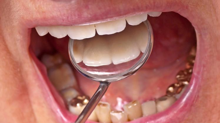 teeth examination , 34570758.jpg, teeth, examination, mirror, dentist, dental, doctor, closeup, gold, mouth, jar, front,
