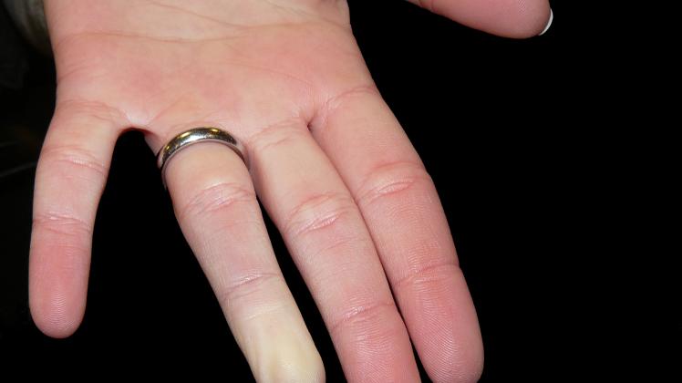 Die weißen Finger _ Das Raynaud-Phänomen trifft vor allem Frauen
