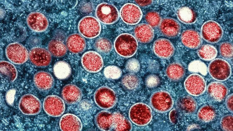 ARCHIV - Eine kolorierte transmissionselektronenmikroskopische Aufnahme von Partikeln des Affenpockenvirus (rot) in einer infizierten Zelle (blau), die im Labor gezüchtet wurde. Foto: Niaid/Niaid/Planet Pix via ZUMA Press Wire/dpa