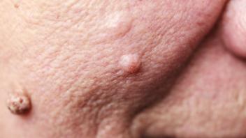 Details of senior woman face. Elderly pensioner female, dermal fibroma close up. (Voyagerix)