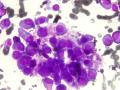 Microscopic image of Multiple Myeloma Multiple Myeloma is type of cancer it occurs then a plasma c