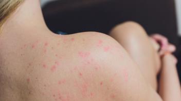 Close  up  Allergy  rash,  Around  Back  view  of  human  with  dermatitis  problem  of  rash  ,Alle