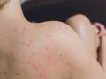 Close  up  Allergy  rash,  Around  Back  view  of  human  with  dermatitis  problem  of  rash  ,Alle