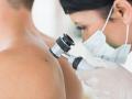 Eine Ärztin untersucht beim Hautkrebs-Screening einen Leberfleck auf dem Rücken eines Mannes