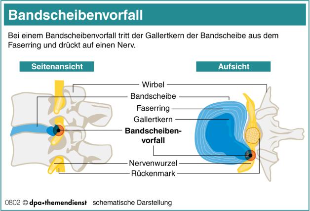 Wie Kommt Es Zu Einem Bandscheibenvorfall www.noz.de