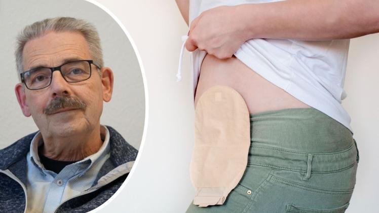 Nach Darmkrebs: Wieso ein Emslnder ein Stoma wollte