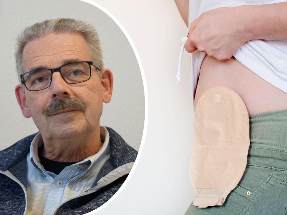 Nach Darmkrebs: Wieso ein Emslnder ein Stoma wollte