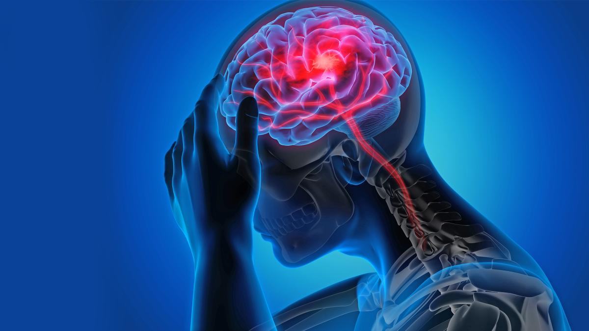 Schlaganfall bei Jüngeren: Alarming Trend und die Gründe dafür – Was Neurologen raten