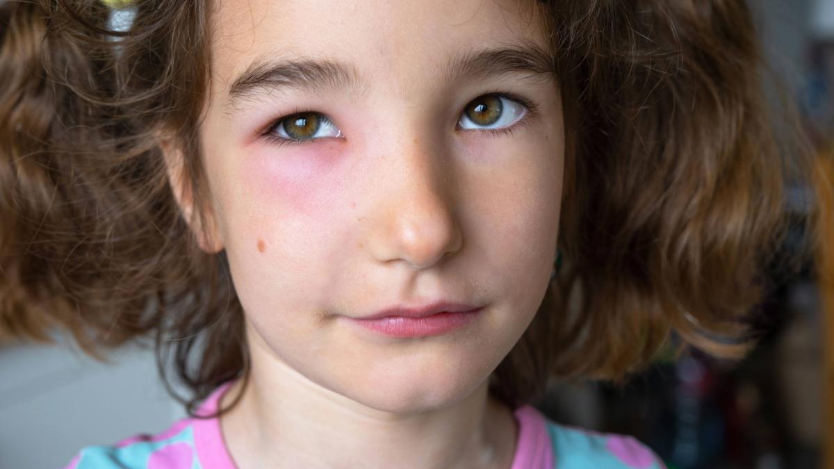 Experte-kl-rt-auf-Dann-sollten-Sie-bei-einem-Insektenstich-zum-Arzt-gehen
