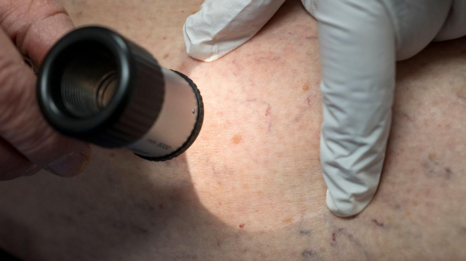 Besorgniserregender Trend: Deutlich mehr Hautkrebsfälle in Niedersachsen