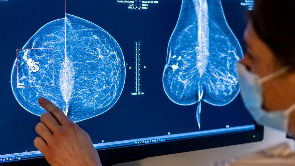 Mammogram Screening in NRW: Why Many Women Skip Breast Cancer Vorsorge